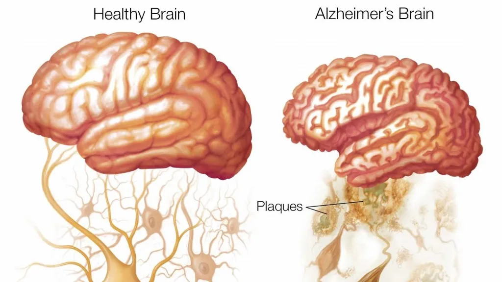 Don't say it don't use it - Alzheimer's treatments and the stats vs effect dilemma