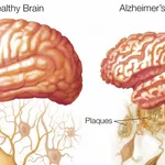 Don't say it don't use it - Alzheimer's treatments and the stats vs effect dilemma