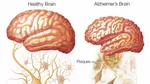 Don't say it don't use it - Alzheimer's treatments and the stats vs effect dilemma
