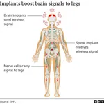 Brain Chips in Humans