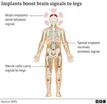 Brain Chips in Humans