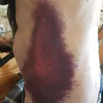 Bruising from COVID vaccines?