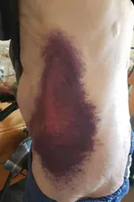 Bruising from COVID vaccines?
