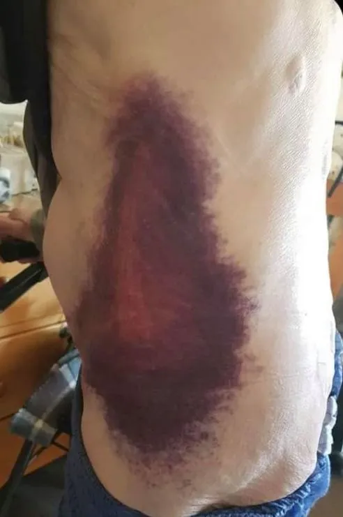 Bruising from COVID vaccines?